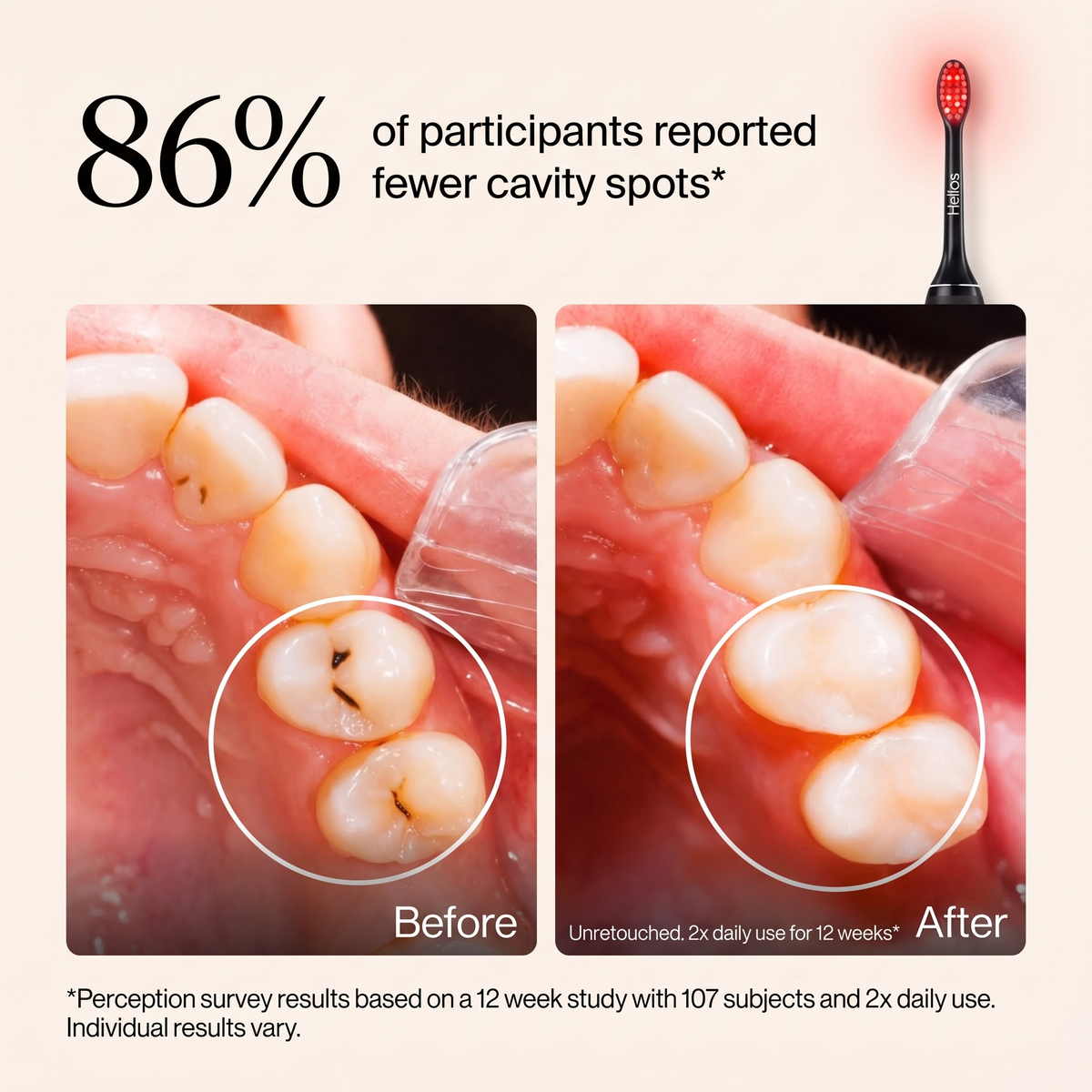 Helios Light Therapy Toothbrush