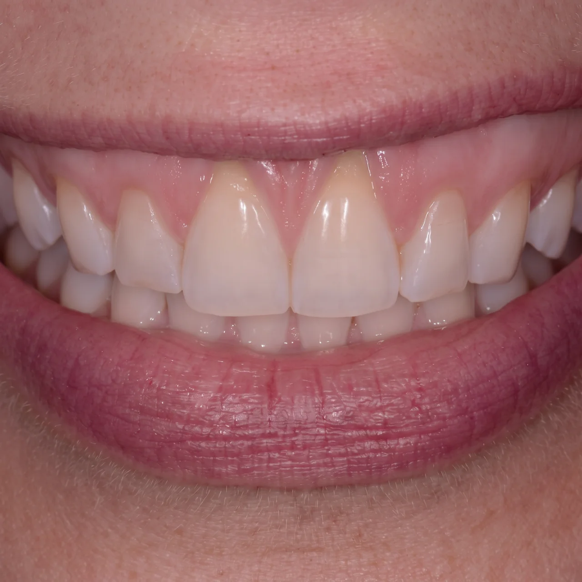 Her Dentist Asked What Changed — Day 01