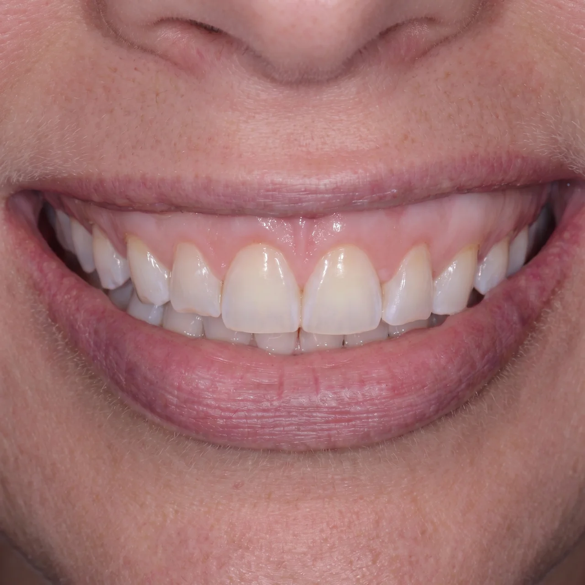 Her Dentist Asked What Changed — Day 30