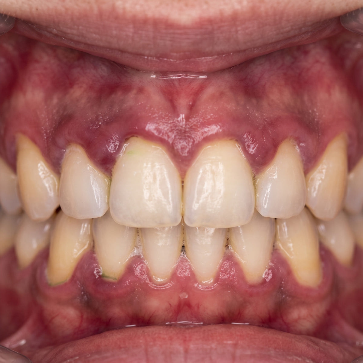Healthier Gums — Day 01