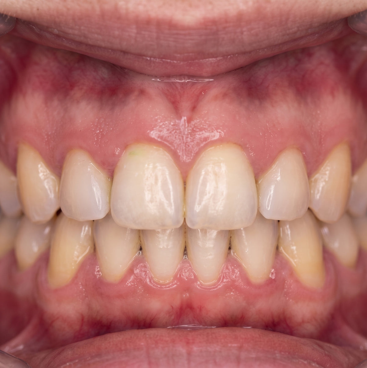 Healthier Gums — Day 30